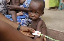 FILE- A doctor attends to a malnourished child at a refugee camp in Yola, Nigeria. Sunday, May 3, 2015. 
