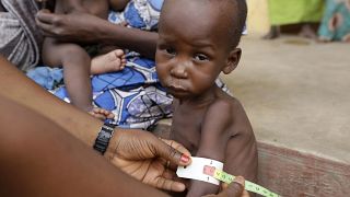 FILE- A doctor attends to a malnourished child at a refugee camp in Yola, Nigeria. Sunday, May 3, 2015.