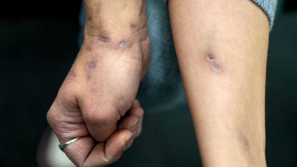 Xylazine: Flesh-rotting ‘zombie’ drug claims first victim in Europe