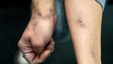 Xylazine-induced lesions cover Amy Treglia's arms and other part of her body. Continued use of the drug causes abscesses that can require amputation.