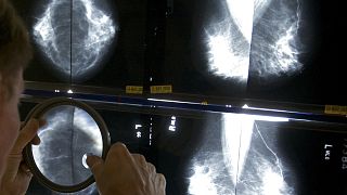 أخصائي الأشعة يفحص صور الثدي بالأشعة السينية في لوس أنجلوس