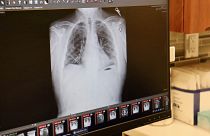  صورة بالأشعة السينية لرئتي مريض في مستشفى نورث وسترن ميديسن في شيكاغو