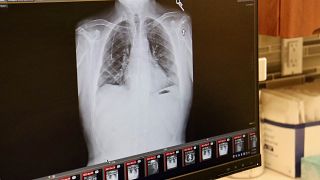 صورة بالأشعة السينية لرئتي مريض في مستشفى نورث وسترن ميديسن في شيكاغو