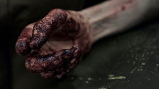 A mão de uma vítima da invasão russa da Ucrânia