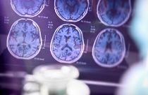 A new Alzheimer's drug has just been granted full approval by the US Food and Drug Administration.
