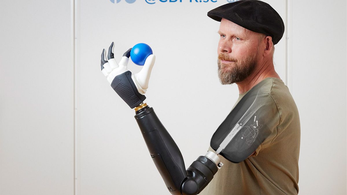 New bionic hand allows users to control each finger with