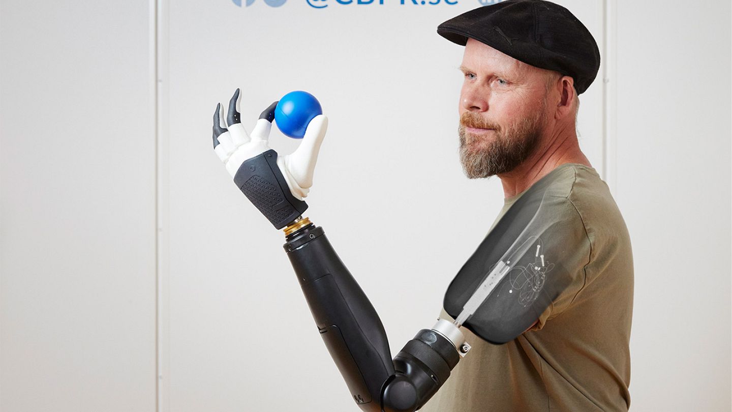 bionic arm prosthetics