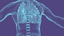 İngiltere'deki araştırmacılar, kanseri tedavi etmek için akciğerlerin derinliklerine ulaşabilen bir robot dokunacını test etti.