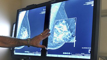 صورة أشعة لفحص وجود خلايا سرطانية في ثديي امرأة