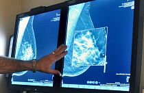 انجام آزمایش ماموگرافی