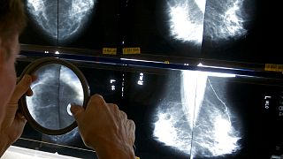 A radiologist uses a magnifying glass to check mammograms for breast cancer in Los Angeles.