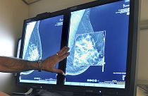 Mamografi taraması