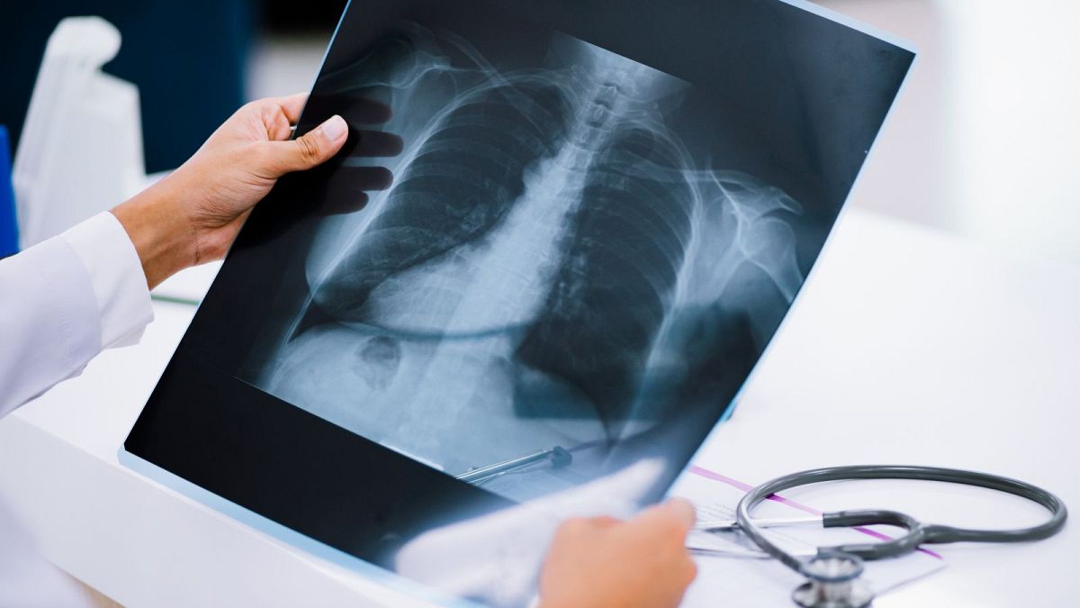 Ein Arzt sieht sich eine Röntgenaufnahme der Brust an.