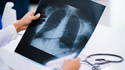 A doctor looks at a chest radiograph.