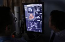 Ultrasound and MRI images are combined to increase accuracy of taking biopsies from the prostate of a patient in California, 2014.