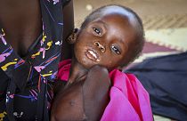 Sudan'da yetersiz beslenmeye bağlı hastalıklar nedeniyle çok sayıda çocuk hayatını kaybediyor