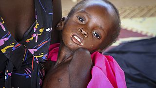 Sudan'da yetersiz beslenmeye bağlı hastalıklar nedeniyle çok sayıda çocuk hayatını kaybediyor