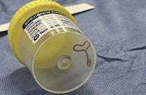 Круглый червь-паразит, найденный в мозгу 64-летней пациентки в Австралии