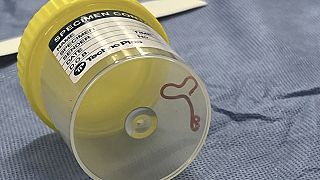 A parasite in a specimen jar at a Canberra hospital in Australia