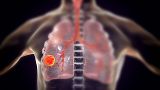 Yeni akciğer kanseri aşısı ölüm riskini yüzde 41 oranında azaltabilir