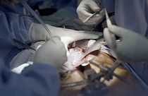 Doktorlar beyin ölümü gerçekleşmiş insana naklettikleri domuz böbreğini iki ay sonunda çıkardı