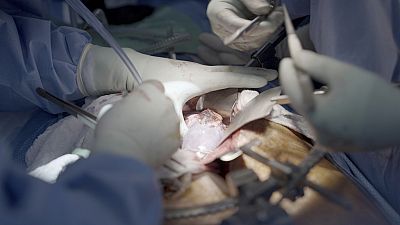 Doktorlar beyin ölümü gerçekleşmiş insana naklettikleri domuz böbreğini iki ay sonunda çıkardı