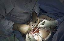 يستعد الجراحون في جامعة نيويورك لانغون هيلث لزراعة كلية خنزير في رجل ميت دماغياً في نيويورك- 14 يوليو 2023.
