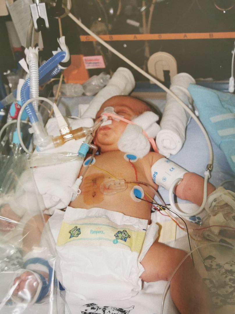 Théo Grataloup, born with several malformations due to glyphosate.