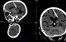 عکس سی‌تی‌اسکن از سوزن در مغز بیمار ۸۰ ساله