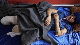 الطفلة الفلسطينية ليان الباز التي بترت ساقاها في قصف إسرائيلي على قطاع غزة تتلقى العلاج في مستشفى ناصر بخان يونس