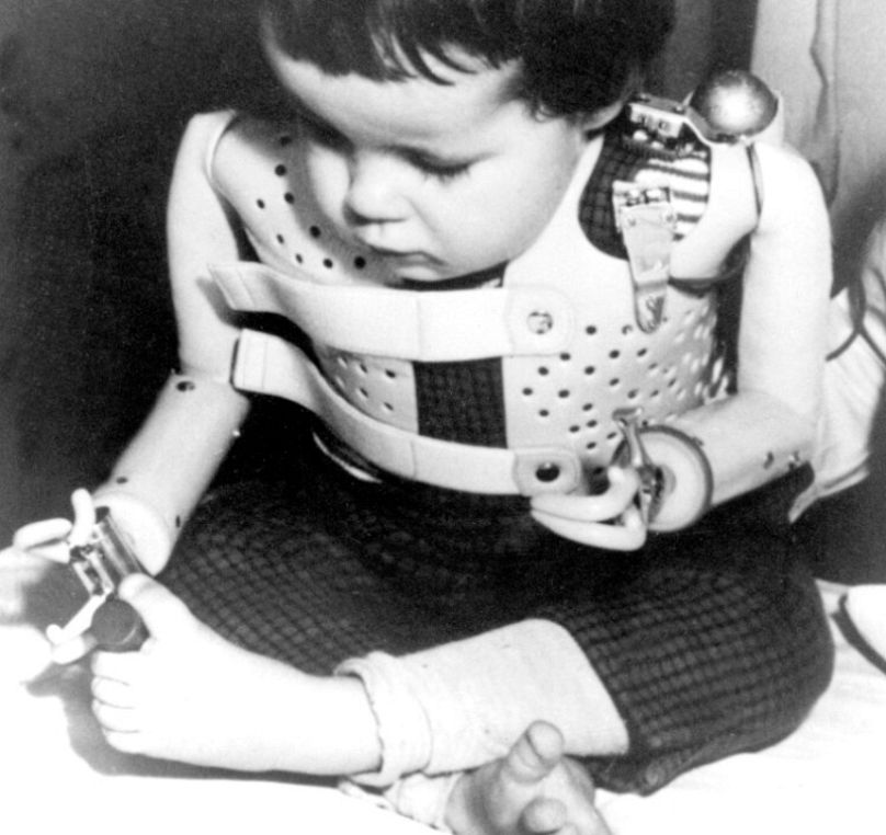 Annesinin Talidomid kullanması sonucu kolsuz doğan ve 1965 yılında yapay kol takılan üç yaşındaki bir çocuk