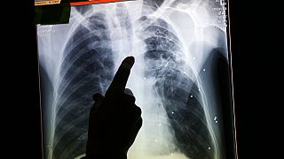  В тази фотография от 16 октомври 2013 година рентгенограф показва рентгенова фотография, направена в предишното на пациент в Ирландия, който е бил диагностициран с туберкулоза, в микробус в Лондон. 