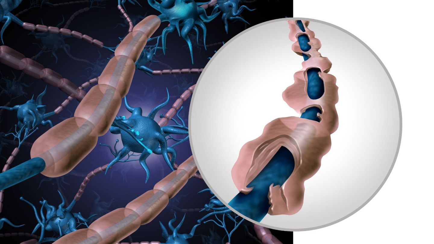 According to Cambridge researchers, MS may be healed by injecting stem cells into the brain.