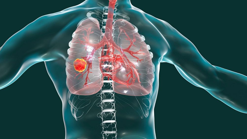 Scientists discover how a key protein can help stop lung cancer spreading