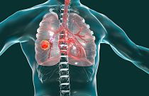 A new study found how a protein plays a key role in the spread of lung cancer. It might pave the way for creating new anti-cancer medication.