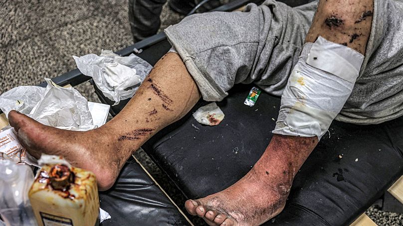 پاهای زخمی یک فلسطینی آزاد شده از بازداشت ارتش اسرائیل