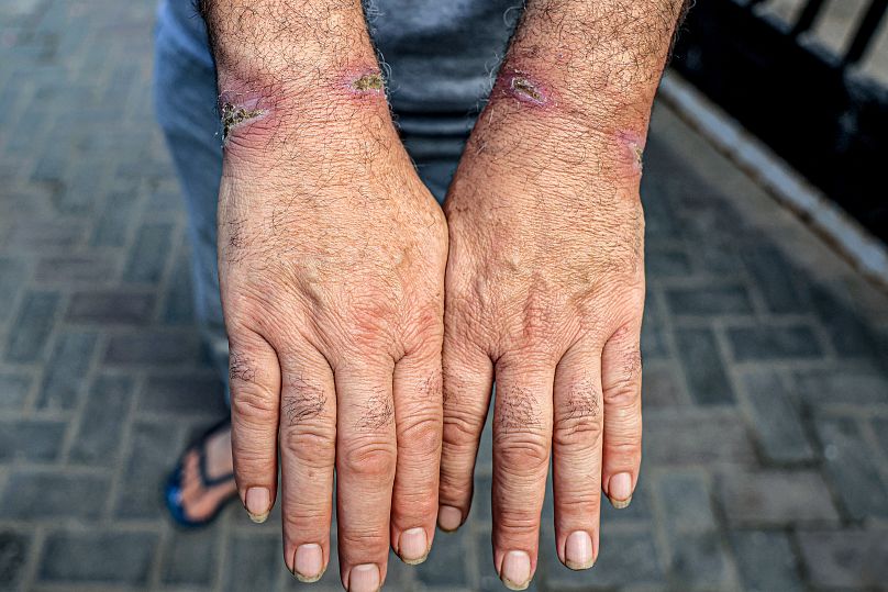 آثار زخم‌های عمیق روی مچ یکی از فلسطینیان آزاد شده از بازداشت ارتش اسرائیل در غزه