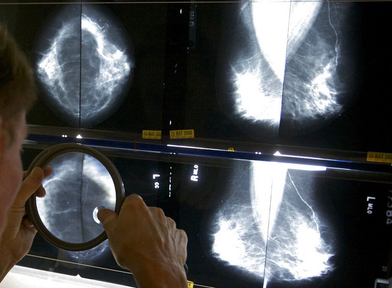 متاستاز به دیگر نقاط بدن یکی از مشکلات عمده سرطان پستان به شمار می‌رود