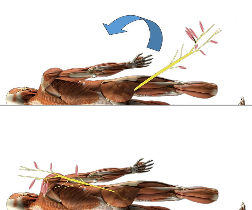 Surgeons transferred a part of the sciatic nerve to the brachial plexus of the patient.