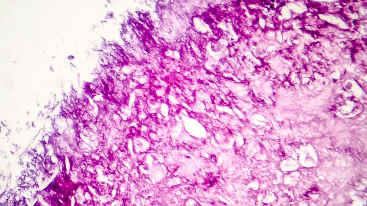 Un ejemplo de células de melanoma.