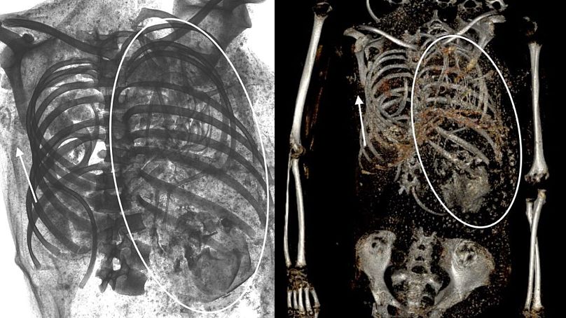 آثار جنین دوم در عکسبرداری پرتو ایکس از مومیایی