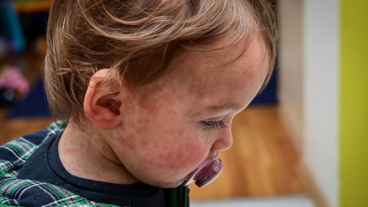 ‘Alarming rise’ in measles cases in Europe as ‘national incident’ declared in UK thumbnail