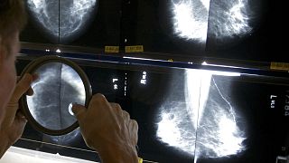 Mammográfiai vizsgálat Los Angelesben