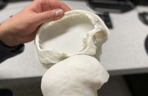 3D-nyomtatású koponyapótlást kapott egy kisfiú Ausztriában