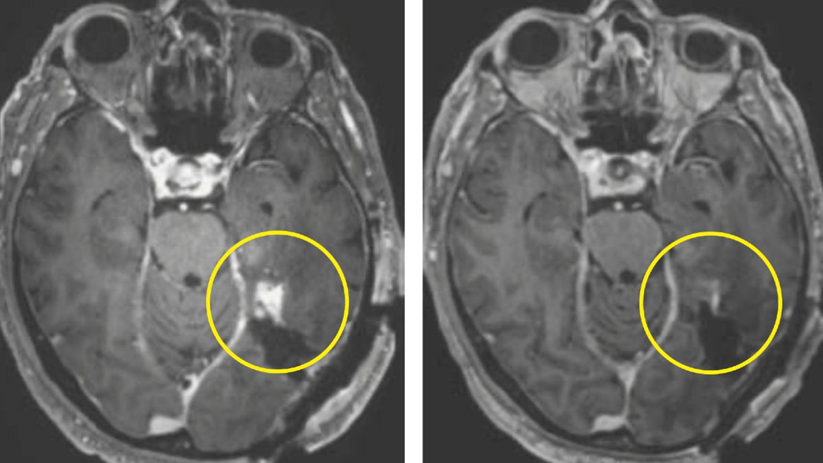 A new strategy to attack aggressive brain cancer shrank tumours in two early tests thumbnail