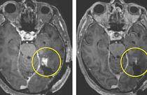 This combination of MRI scan images in March 2024 shows the progress of a glioblastoma patient.