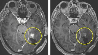 This combination of MRI scan images in March 2024 shows the progress of a glioblastoma patient.