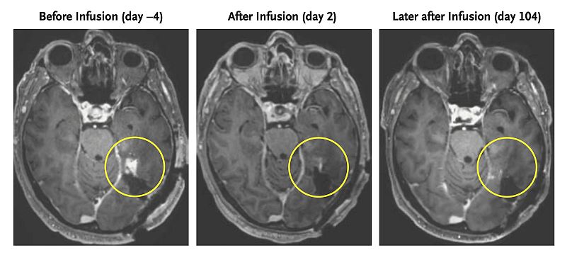 This combination of MRI scan images shows the progress of a glioblastoma patient who received CAR-T therapy.
