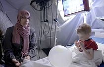 طفل يعاني من سوء التغذية الحاد في غزة
