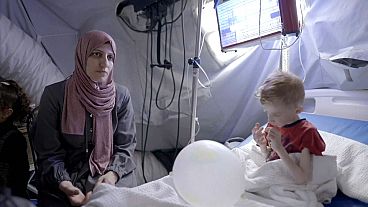طفل يعاني من سوء التغذية الحاد في غزة
